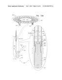 TECHNIQUES FOR PERCUTANEOUS MITRAL VALVE REPLACEMENT AND SEALING diagram and image