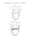 SUBCHONDRAL TREATMENT TO PREVENT THE PROGRESSION OF OSTEOARTHRITIS OF THE     JOINT diagram and image