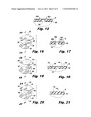 Interlocking Buttress Material Retention System diagram and image