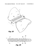 Interlocking Buttress Material Retention System diagram and image