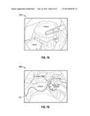 Apparatus and Method for Using Augmented Reality Vision System in Surgical     Procedures diagram and image