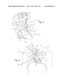 BLOOD FLOW ASSIST DEVICES, SYSTEMS AND METHODS diagram and image