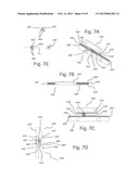 BLOOD FLOW ASSIST DEVICES, SYSTEMS AND METHODS diagram and image