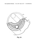 SURGICAL ARTICLES FOR PLACING AN IMPLANT ABOUT A TUBULAR TISSUE STRUCTURE     AND METHODS diagram and image