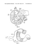 DUODENAL STIMULATION TO INDUCE SATIETY diagram and image