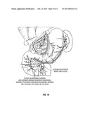 DUODENAL STIMULATION TO INDUCE SATIETY diagram and image