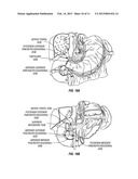 DUODENAL STIMULATION TO INDUCE SATIETY diagram and image