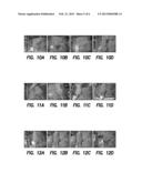 Method for Treating Prostate Cancer diagram and image