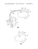 WIRELESS ECG IN IMPLANTABLE DEVICES diagram and image