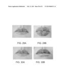 LIP ENHANCEMENT AND ENLARGEMENT DEVICE diagram and image