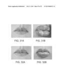 LIP ENHANCEMENT AND ENLARGEMENT DEVICE diagram and image