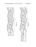 Method Of Treating An Intravascular Site In A Patient, And Thrombolysis     Catheter Therefor diagram and image