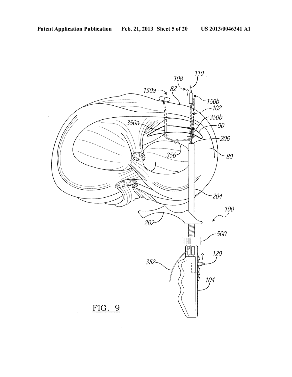 Soft Tissue Repair Device And Associated Methods - diagram, schematic, and image 06