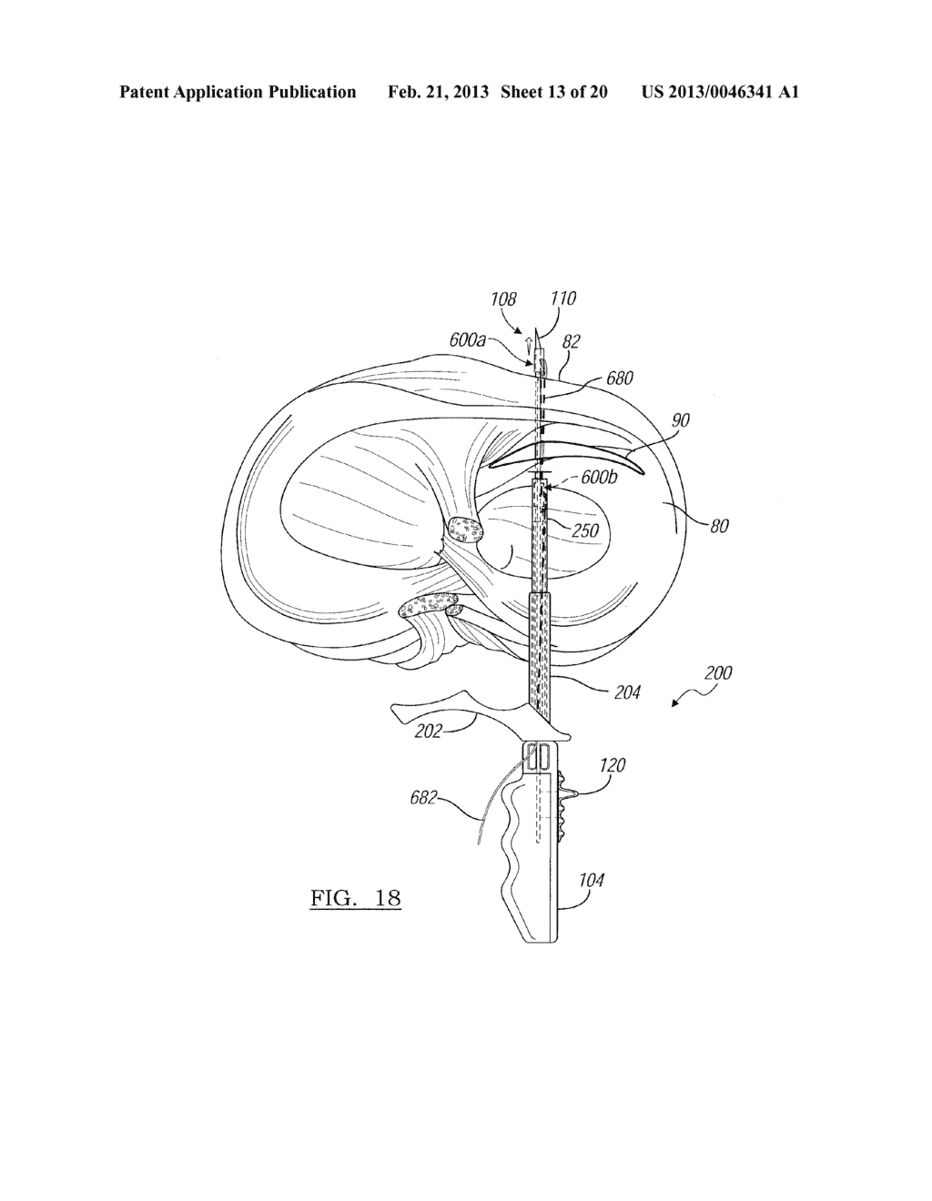 Soft Tissue Repair Device And Associated Methods - diagram, schematic, and image 14