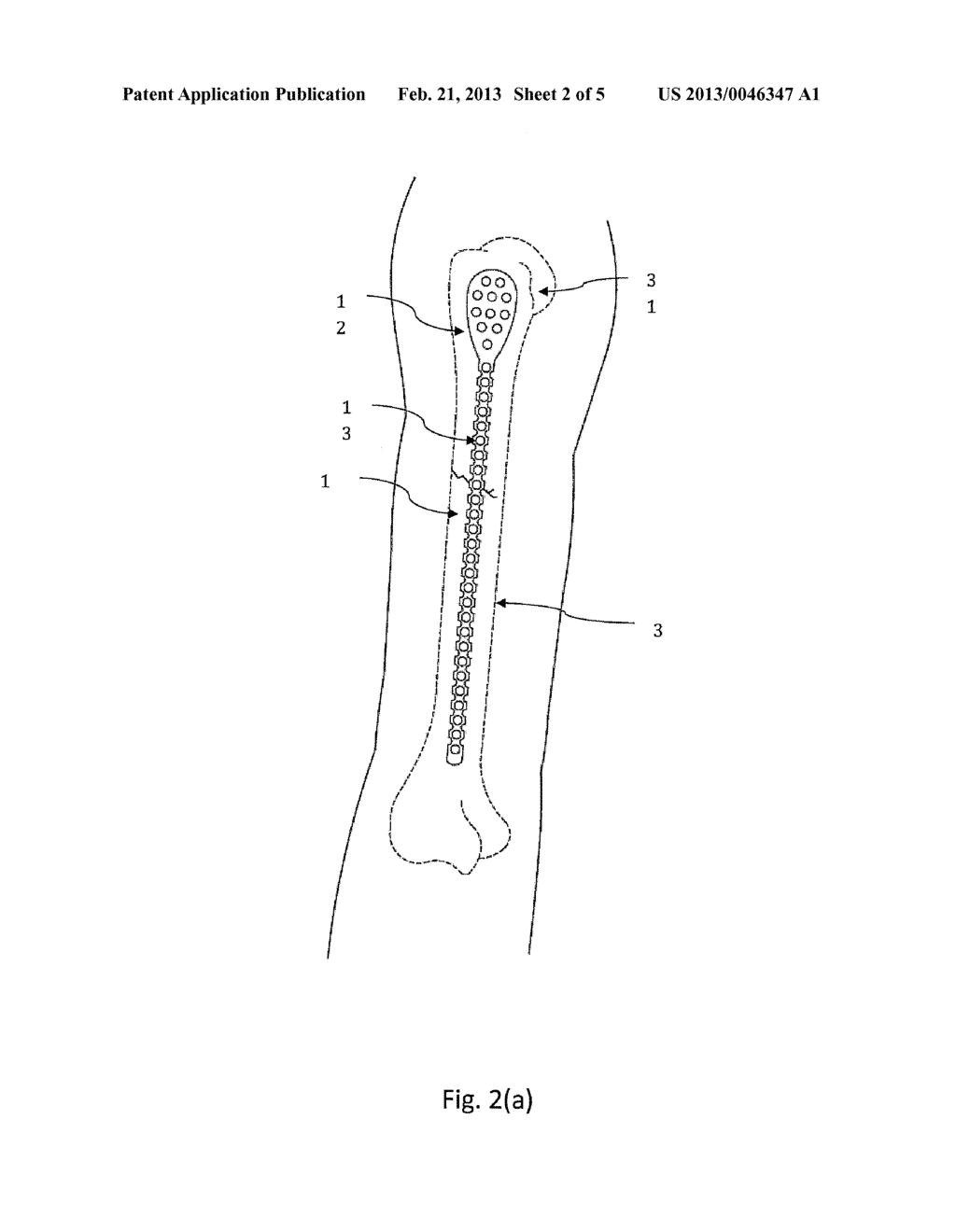 BENDABLE BONE PLATE FOR EXTERNAL FIXATION - diagram, schematic, and image 03