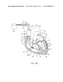 HIGH PHRENIC, LOW CAPTURE THRESHOLD PACING DEVICES AND METHODS diagram and image