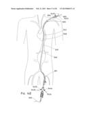 ENDOLUMINAL PROSTHESIS HAVING MULTIPLE BRANCHES OR FENESTRATIONS AND     METHODS OF DEPLOYMENT diagram and image