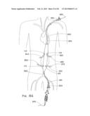 ENDOLUMINAL PROSTHESIS HAVING MULTIPLE BRANCHES OR FENESTRATIONS AND     METHODS OF DEPLOYMENT diagram and image