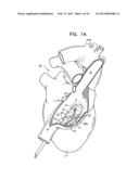 TRICUSPID VALVE REPAIR USING TENSION diagram and image