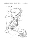 TRICUSPID VALVE REPAIR USING TENSION diagram and image