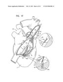 TRICUSPID VALVE REPAIR USING TENSION diagram and image