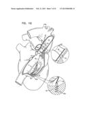 TRICUSPID VALVE REPAIR USING TENSION diagram and image