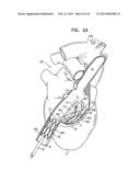 TRICUSPID VALVE REPAIR USING TENSION diagram and image