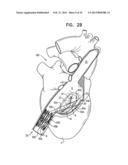 TRICUSPID VALVE REPAIR USING TENSION diagram and image