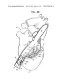 TRICUSPID VALVE REPAIR USING TENSION diagram and image