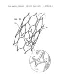 TRICUSPID VALVE REPAIR USING TENSION diagram and image