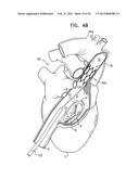 TRICUSPID VALVE REPAIR USING TENSION diagram and image