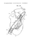 TRICUSPID VALVE REPAIR USING TENSION diagram and image