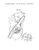 TRICUSPID VALVE REPAIR USING TENSION diagram and image