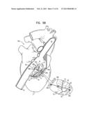 TRICUSPID VALVE REPAIR USING TENSION diagram and image