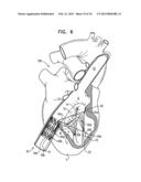 TRICUSPID VALVE REPAIR USING TENSION diagram and image