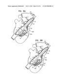 TRICUSPID VALVE REPAIR USING TENSION diagram and image