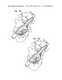 TRICUSPID VALVE REPAIR USING TENSION diagram and image