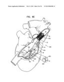 TRICUSPID VALVE REPAIR USING TENSION diagram and image