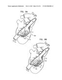 TRICUSPID VALVE REPAIR USING TENSION diagram and image