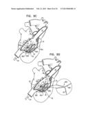 TRICUSPID VALVE REPAIR USING TENSION diagram and image