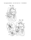 TRICUSPID VALVE REPAIR USING TENSION diagram and image