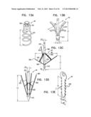 TRICUSPID VALVE REPAIR USING TENSION diagram and image