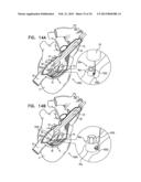 TRICUSPID VALVE REPAIR USING TENSION diagram and image