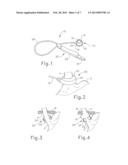 IMPLANTABLE MEDICAL PORT WITH ALIGNMENT FEATURE diagram and image