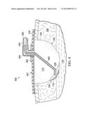 REDUCED-PRESSURE TREATMENT AND DEBRIDEMENT SYSTEMS AND METHODS diagram and image
