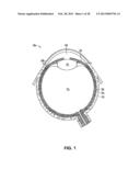 SUSTAINED RELEASE DELIVERY OF ACTIVE AGENTS TO TREAT GLAUCOMA AND OCULAR     HYPERTENSION diagram and image