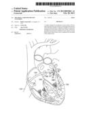 ABLATION CATHETER FOR VEIN ANATOMIES diagram and image