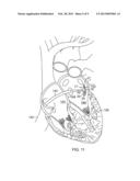 ABLATION CATHETER FOR VEIN ANATOMIES diagram and image