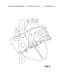 COMPARISON OF RIGHT-VENTRICULAR AND LEFT-VENTRICULAR CONTRACTION USING AN     ACCELEROMETER IN AN ARTERY CLOSE TO THE HEART diagram and image