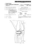 BIOACTIVE BONE GRAFT SUBSTITUTE diagram and image